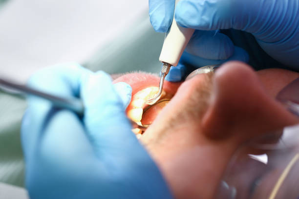 Best Emergency Wisdom Teeth Removal in South San Jose Hills, CA