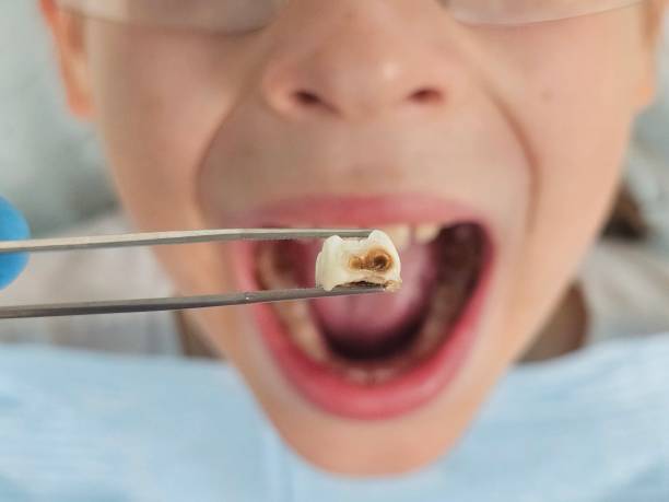 Best Emergency Treatment for Dental Infections or Abscesses in South San Jose Hills, CA