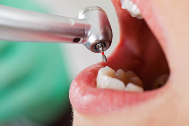 Best Urgent Care for Lost Fillings or Crowns in South San Jose Hills, CA